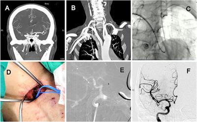 Direct Carotid Artery Exposure for Acute Cerebral Infarction in Hybrid Angiography Suite: Indications and Limitations